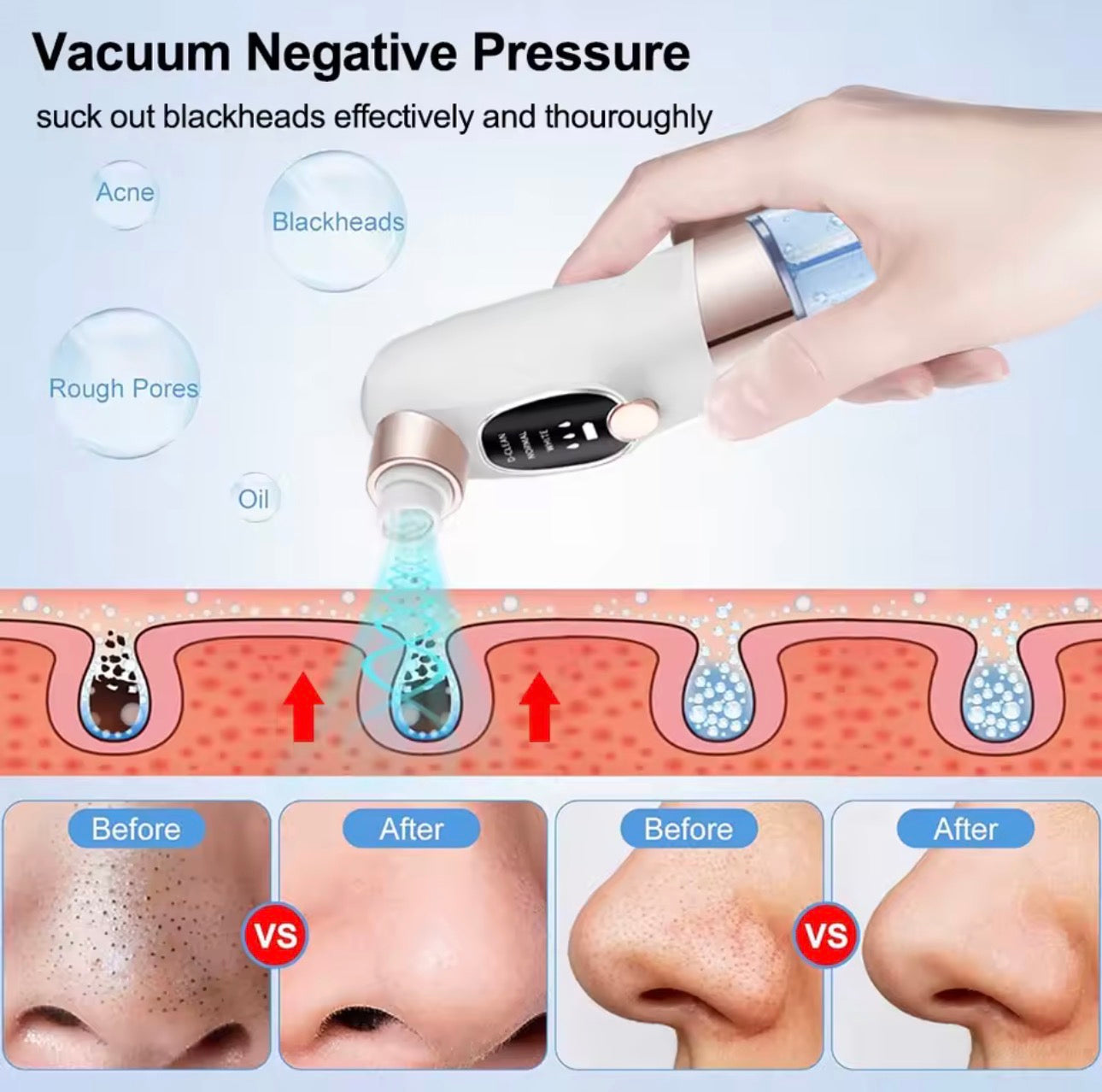 Remove Blackheads in Minutes – Powerful Pore Vacuum Cleaner